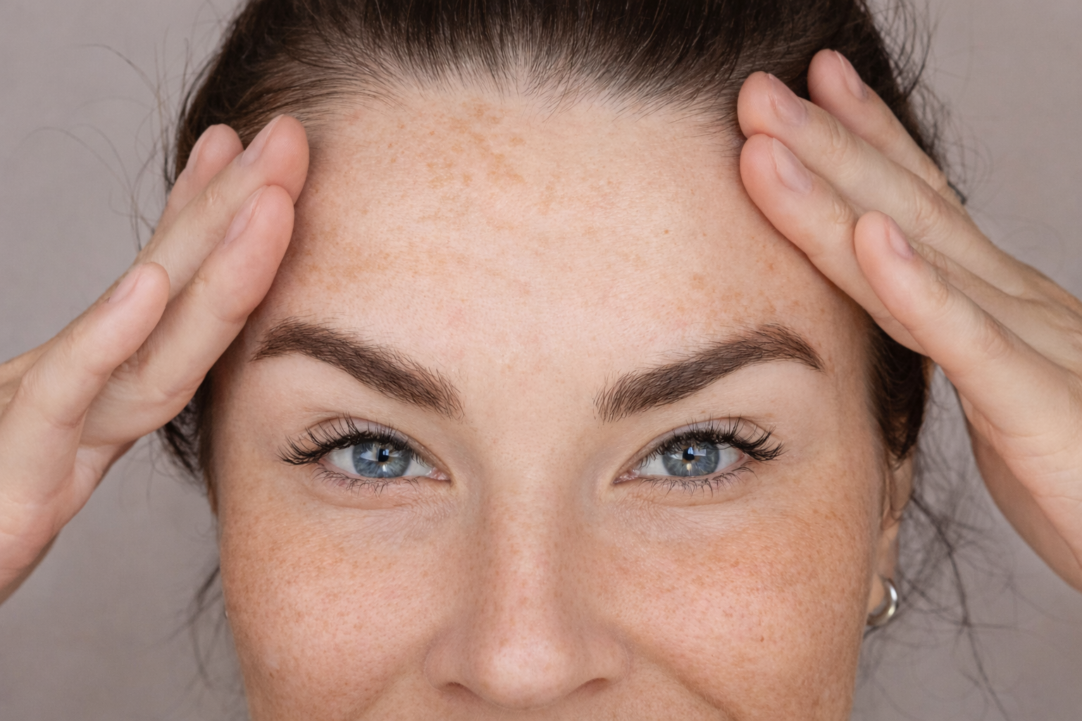 Os maiores erros ao tentar clarear melasma (e por que suas manchas não somem)