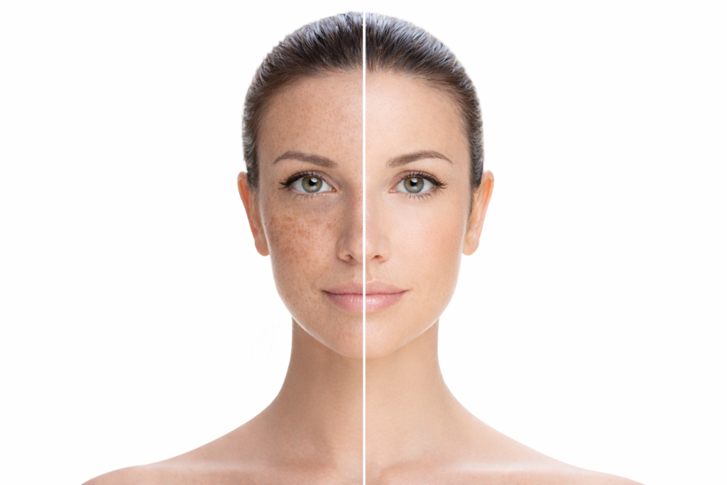 Cuidados com melasma na pele madura — combinação de ativos